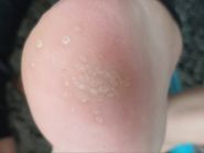 Медичний педикюр, подолог Афанаскіна Жанна фото