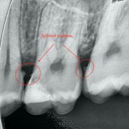 Platinum dent, естетична стоматологія фото