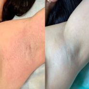 LaserZona, лазерна епбіляція фото