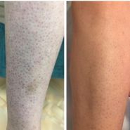 LaserZona, лазерна епбіляція фото