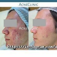 AcneClinic, центр дерматокосметологии фото