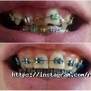 RocketSmile, стоматологія фото