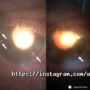 Офтальмологічне відділення ВОКЛ, мікрохірургія ока фото