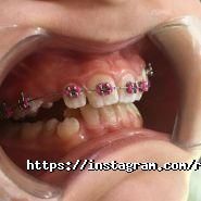 RocketSmile, стоматологія фото