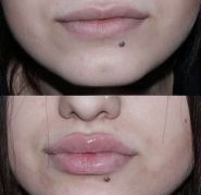 Вікторія Полякова, професійний косметолог-ін'єкціоніст фото