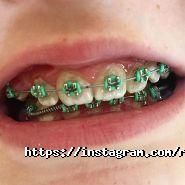 RocketSmile, стоматологія фото