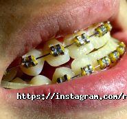 RocketSmile, стоматологія фото