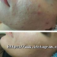 Люмен, лазерна косметологія фото