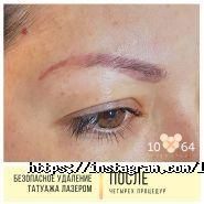 10/64, студія безпечного видалення татуювань і татуажу фото