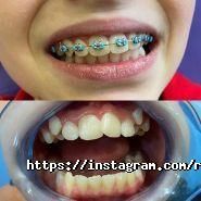 RocketSmile, стоматологія фото