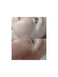 New Skin, лазерна епіляція фото