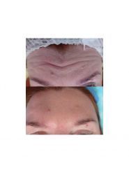 New Skin, лазерна епіляція фото