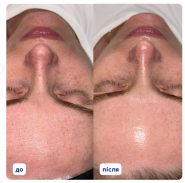 LaserStudio, лазерная эпиляция фото