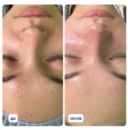 LaserStudio, лазерна епіляція фото