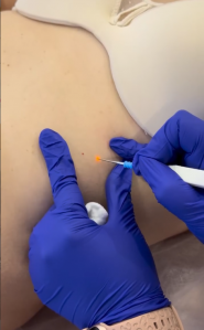 Люменис, центр лазерной эпиляции фото