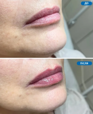 Люменис, центр лазерной эпиляции фото