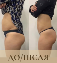 Агатас, апаратна корекція фігури фото