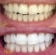 White story, стоматологія фото