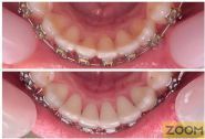 Zoom, стоматологія фото