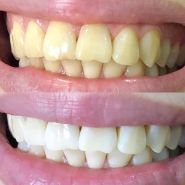 Отбеливание зубов Smile_LAB, салон красоты фото