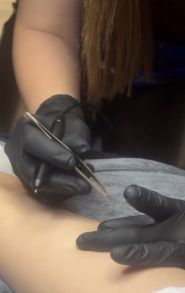 Impulse, лазерна епіляція фото