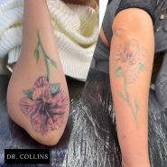 Dr. Collins Киев, Удаление татуировок фото