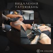 Dr. Collins Київ, Видалення татуювань фото