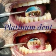 Platinum dent, естетична стоматологія фото