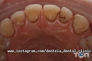 Дентея відгуки фото