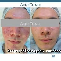 AcneClinic отзывы фото