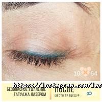 10/64, студія безпечного видалення татуювань і татуажу фото