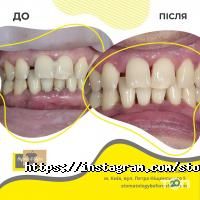 Стоматології Before & After фото