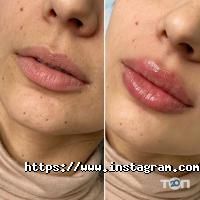 відгуки про Люменіс фото