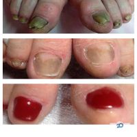 Медичний педикюр, подолог Афанаскіна Жанна - фото 8
