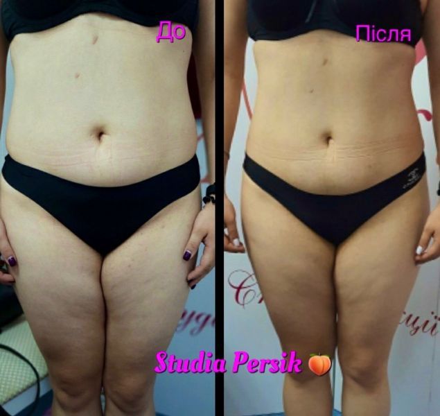 Обзор компаний, что предлагают услуги похудения в г. Черкассы