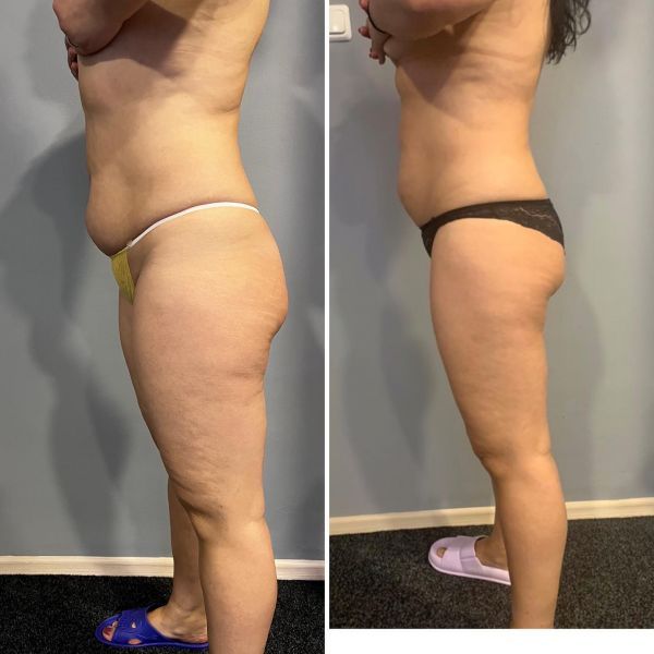 Обзор компаний, что предлагают услуги похудения в г. Львов