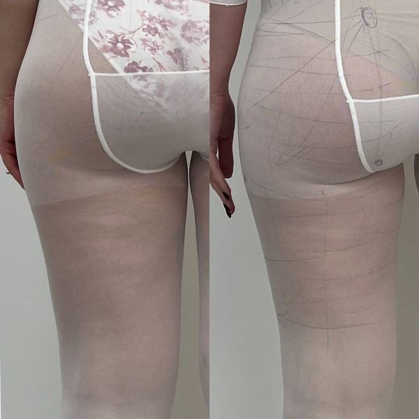 Обзор компаний, что предлагают услуги LPG массажа в г. Винница