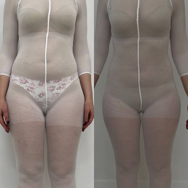 Обзор компаний, что предлагают услуги LPG массажа в г. Винница