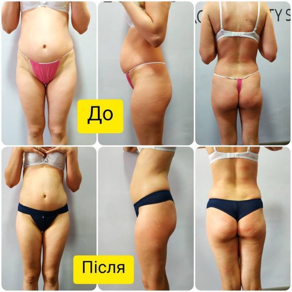 Обзор компаний, что предлагают услуги похудения в г. Львов