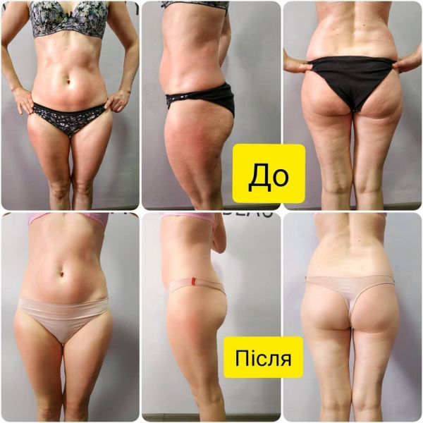 Обзор компаний, что предлагают услуги похудения в г. Львов