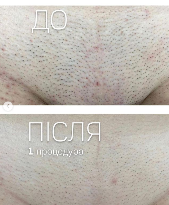 Где сделать лазерную эпиляцию в Виннице до лета? Обзор центров и прайс