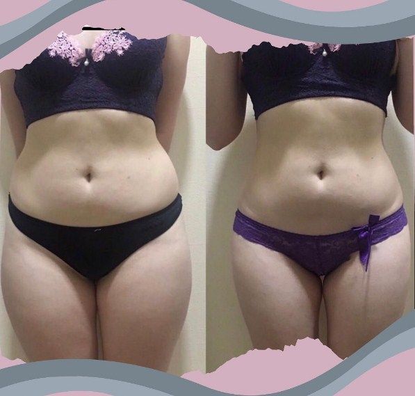 Обзор компаний, что предлагают услуги похудения в г. Ивано-Франковск